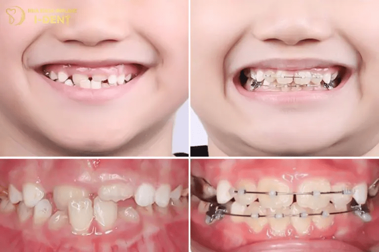 trường hợp niềng răng cho trẻ 10 tuổi
