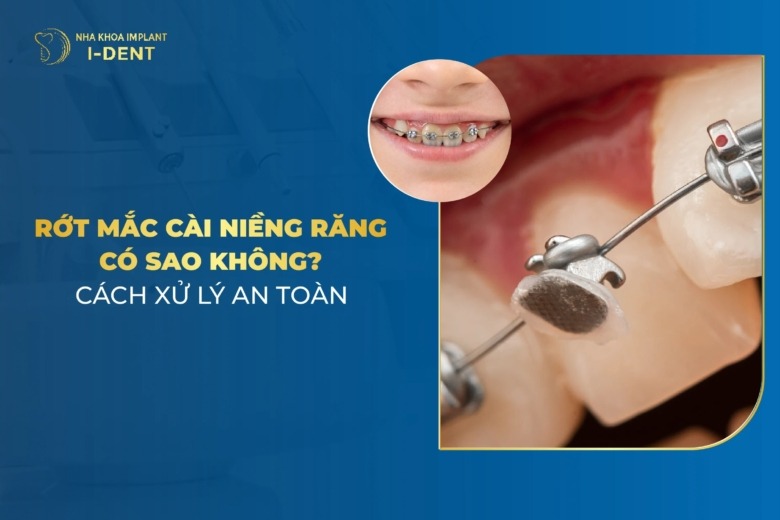 Bị Rớt Mắc Cài Niềng Răng Phải Xử Lý Thế Nào?