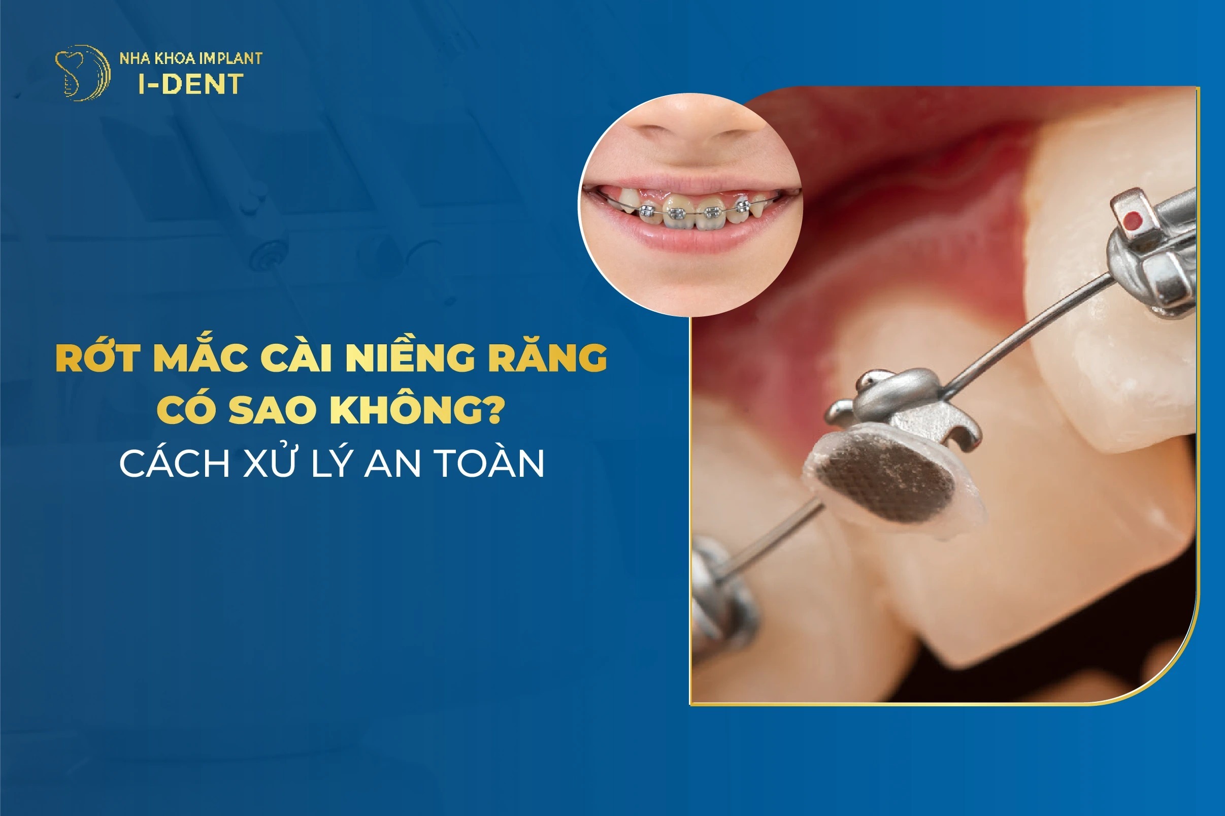 Bị Rớt Mắc Cài Niềng Răng Phải Xử Lý Thế Nào?
