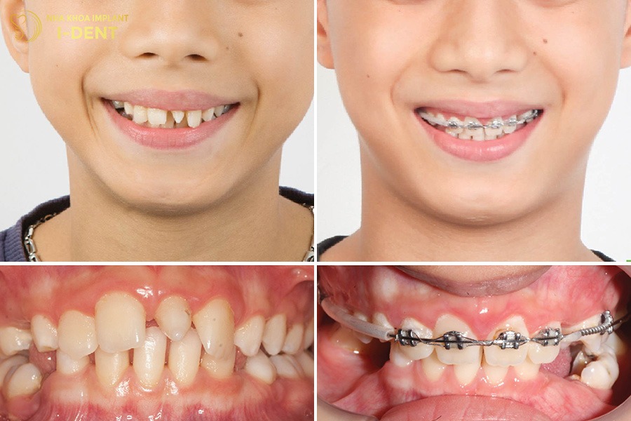 Tùy vào tình trạng răng mà bác sĩ lựa chọn phương pháp niềng phù hợp cho trẻ.