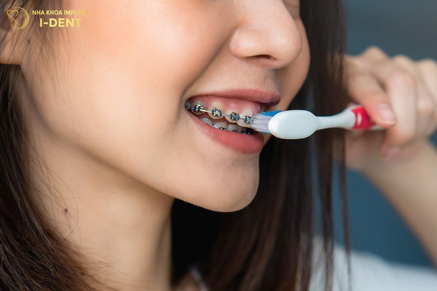 Vệ sinh răng miệng sai cách có thể làm bung mắc cài.