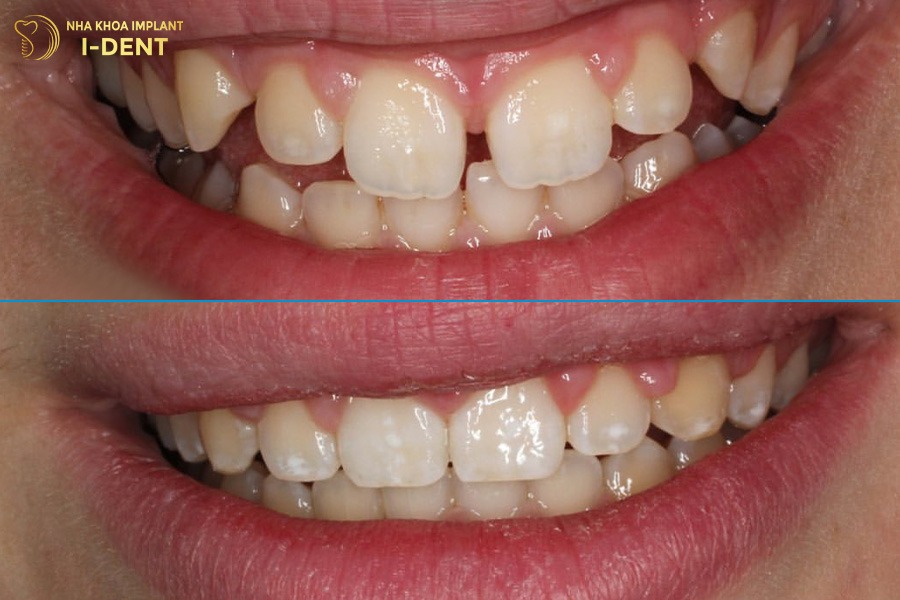 13 tuổi là thời điểm vàng để niềng răng