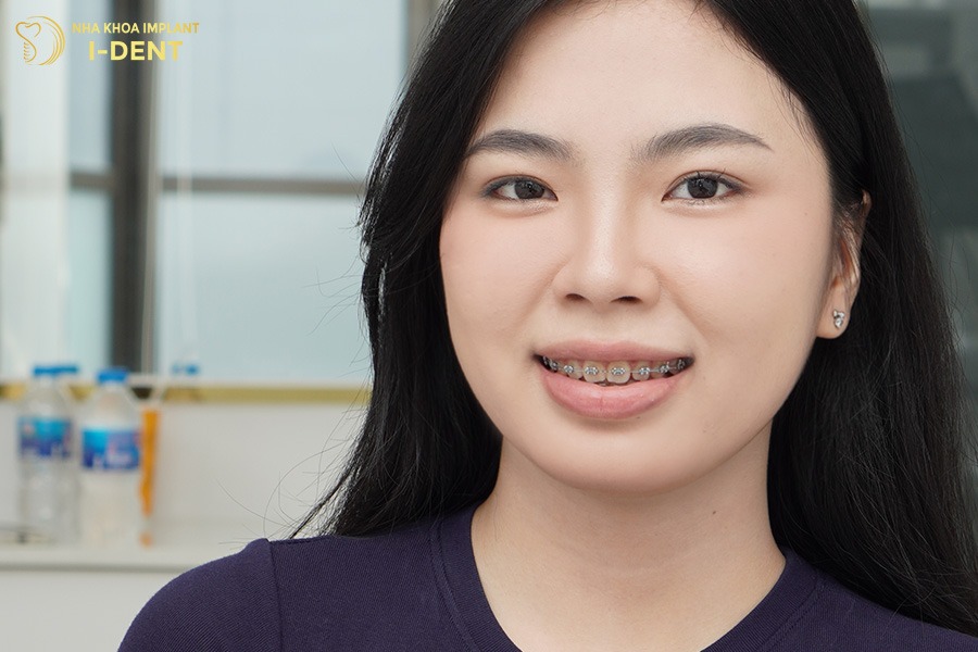 18 tuổi niềng răng mắc cài kim loại