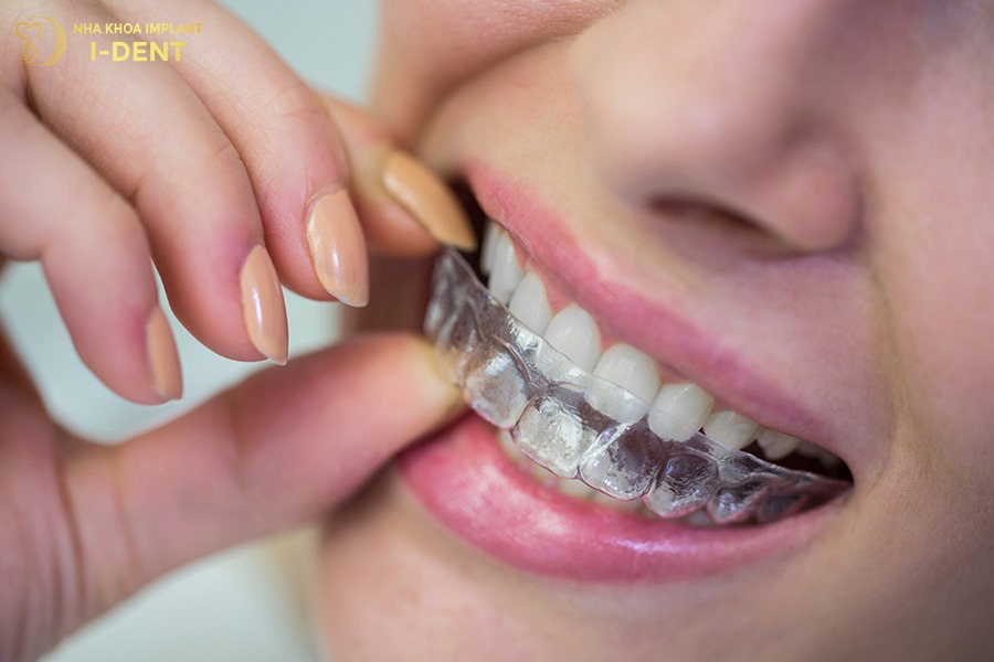 18 tuổi niềng răng trong suốt Invisalign