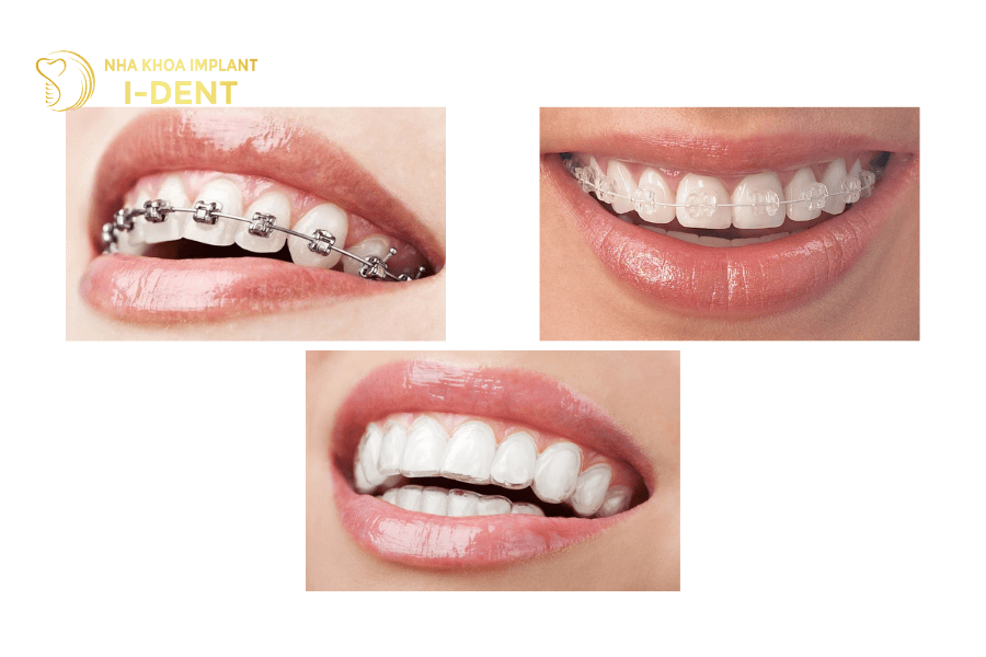 niềng răng cho trẻ 14 tuổi