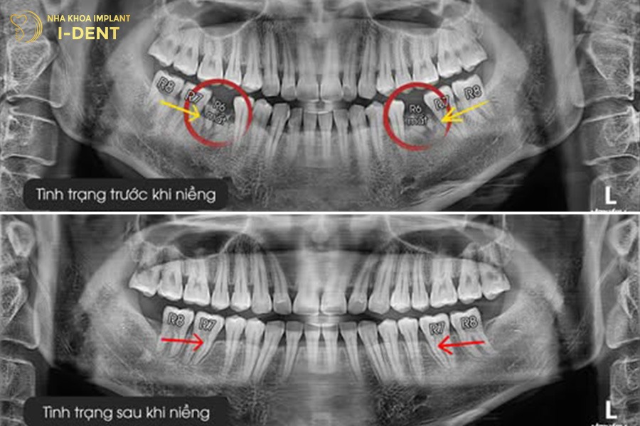 33 tuổi có niềng răng được không