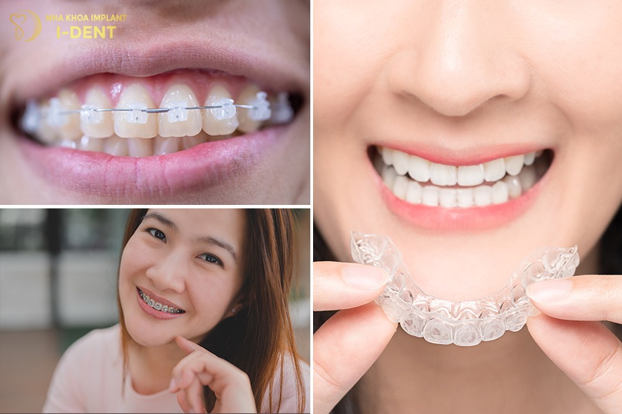 35 tuổi có nên niềng răng