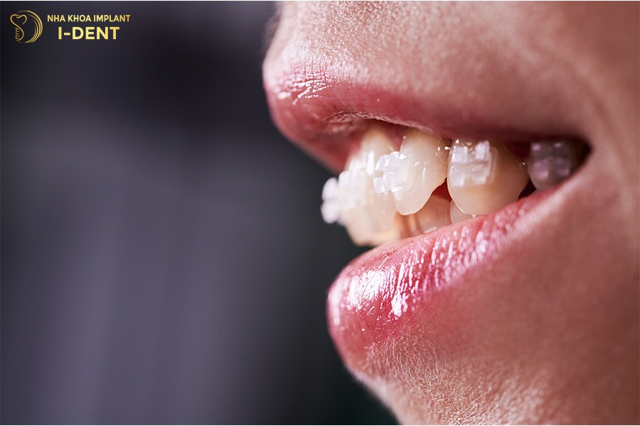 45 có nên niềng răng