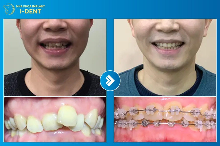 45 có nên niềng răng