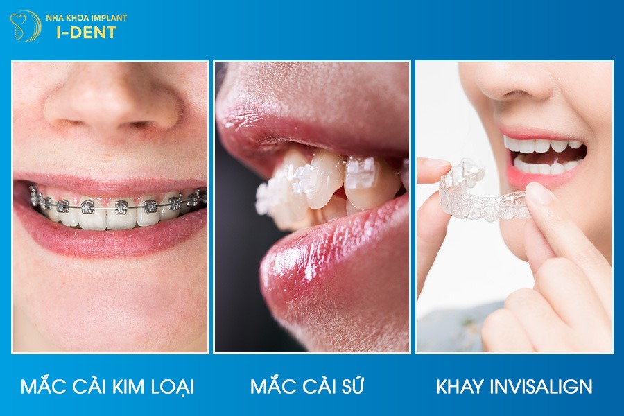 50 tuổi có niềng răng được không