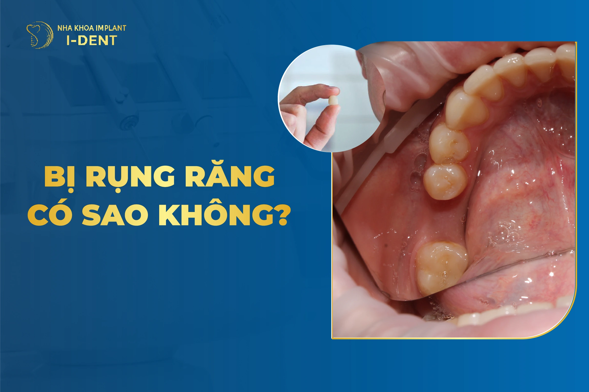 Bị Rụng Răng Có Sao Không? Nguyên Nhân Và Cách Khắc Phục