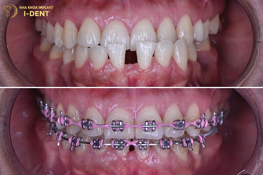 bị móm có niềng răng được không