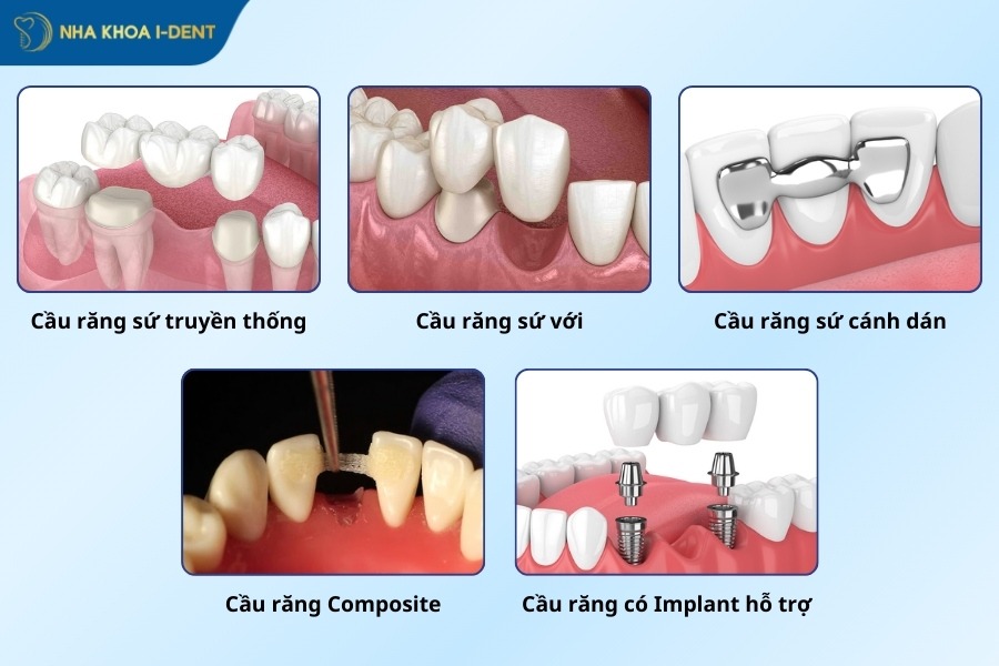 làm răng bắc cầu giá bao nhiêu