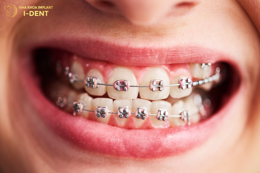 giá niềng răng 2 hàm