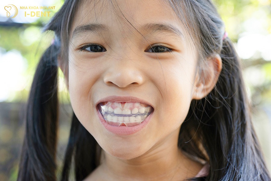 niềng răng trẻ em giá bao nhiêu