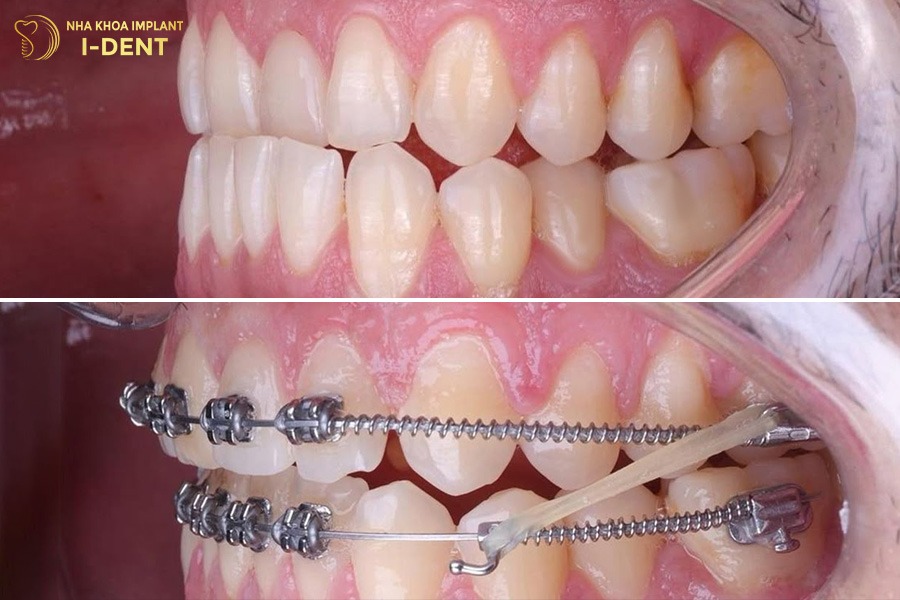 hàm móm có niềng răng được không