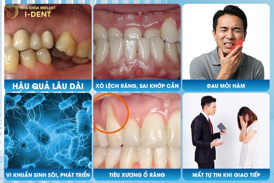 Những ảnh hưởng của mất răng số 7 hàm trên thời gian dài