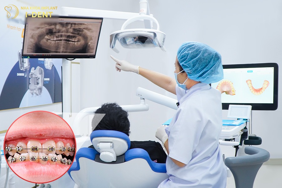 I-Dent là địa chỉ niềng răng móm uy tín