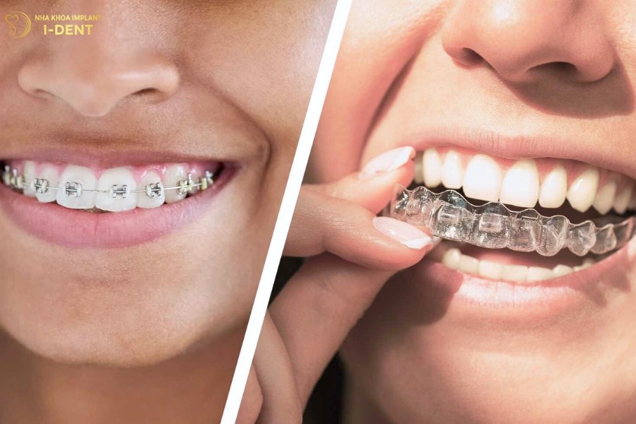 niềng răng invisalign có hiệu quả không