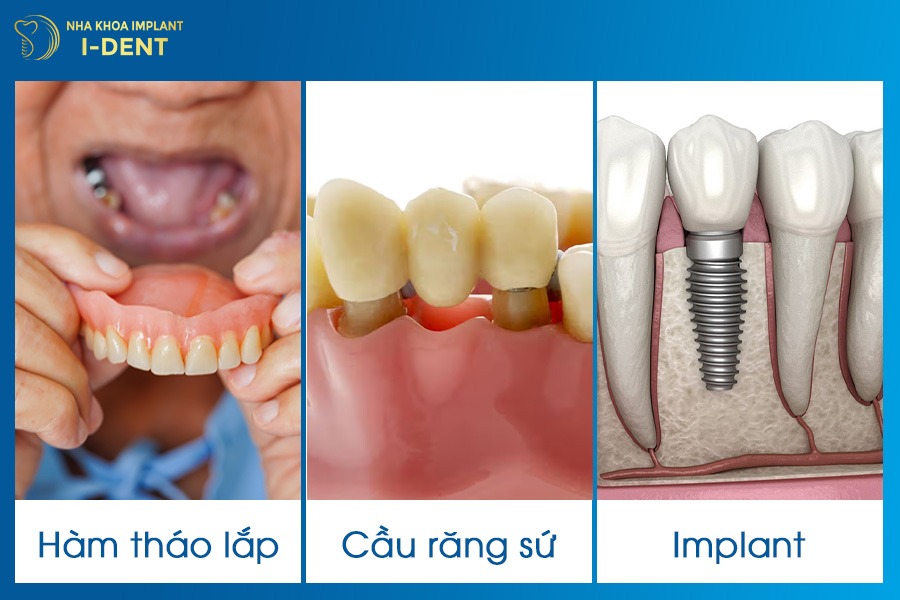 Giải pháp khắc phục tình trạng mất răng số 7 hàm dưới.