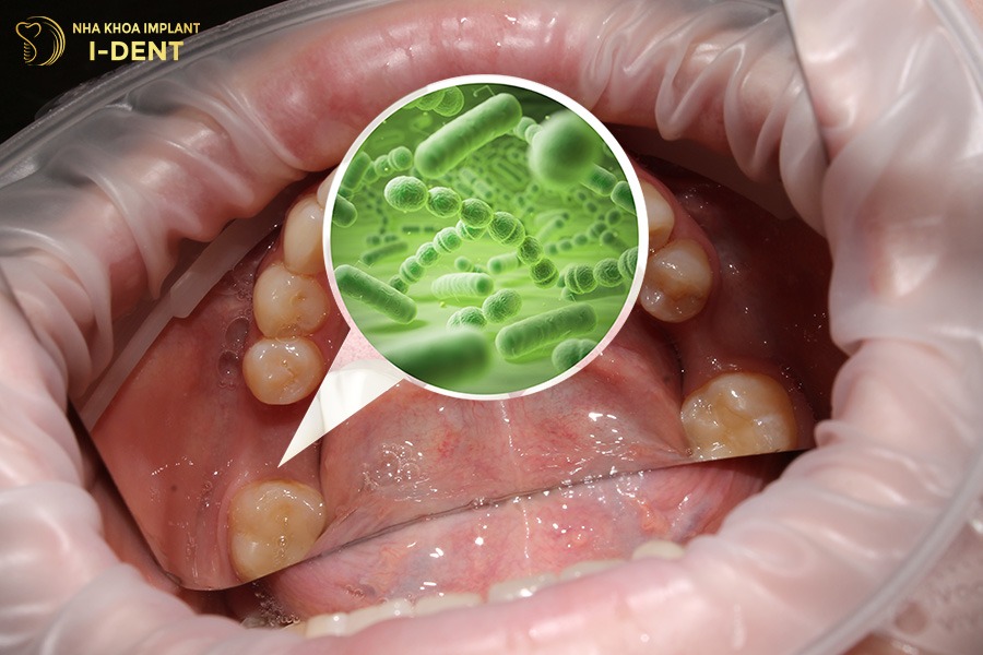 Khoảng trống mất răng là nơi tích tụ vi khuẩn phát triển gây sâu răng, viêm nướu.