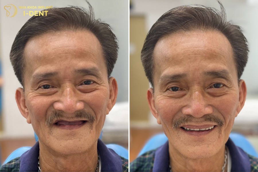 Tiêu xương răng làm cho khuôn mặt biến dạng.