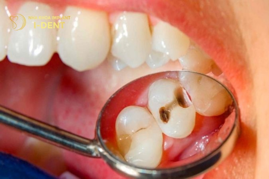 Răng số 5 bị sâu hoặc viêm thfi cần phải nhổ trước khi niềng.