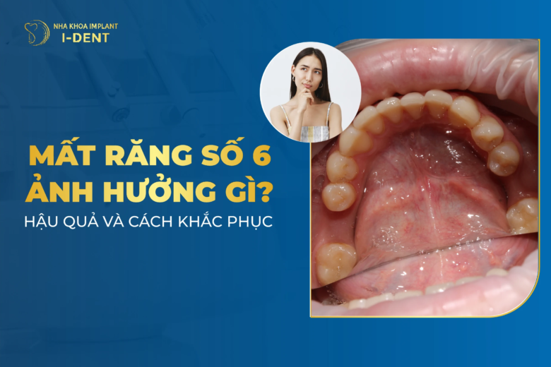 Hậu quả khi mất răng số 6 và giải pháp phục hình