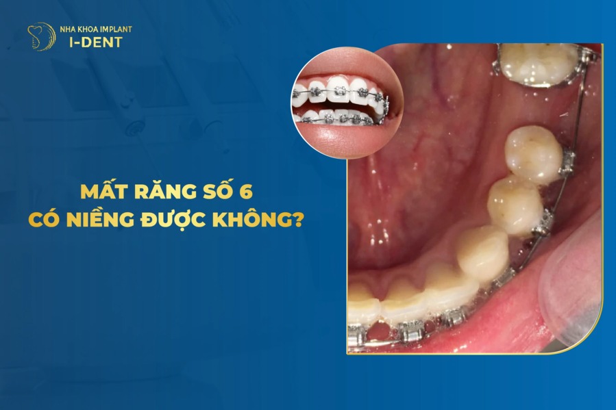 Mất Răng Số 6 Có Niềng Được Không?
