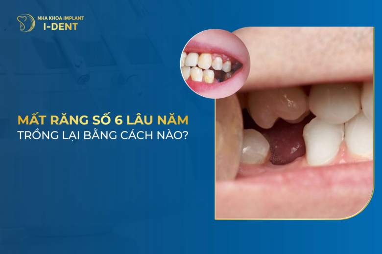 Mất Răng Số 6 Lâu Năm Trồng Lại Bằng Cách Nào?
