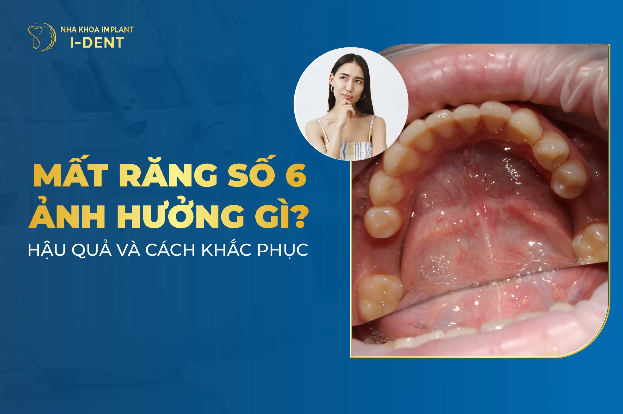 Hậu quả khi mất răng số 6 và giải pháp phục hình