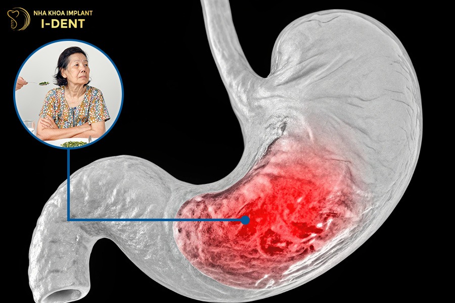 Mất răng số 7 hàm dưới khiến thức ăn không được nghiền kỹ.