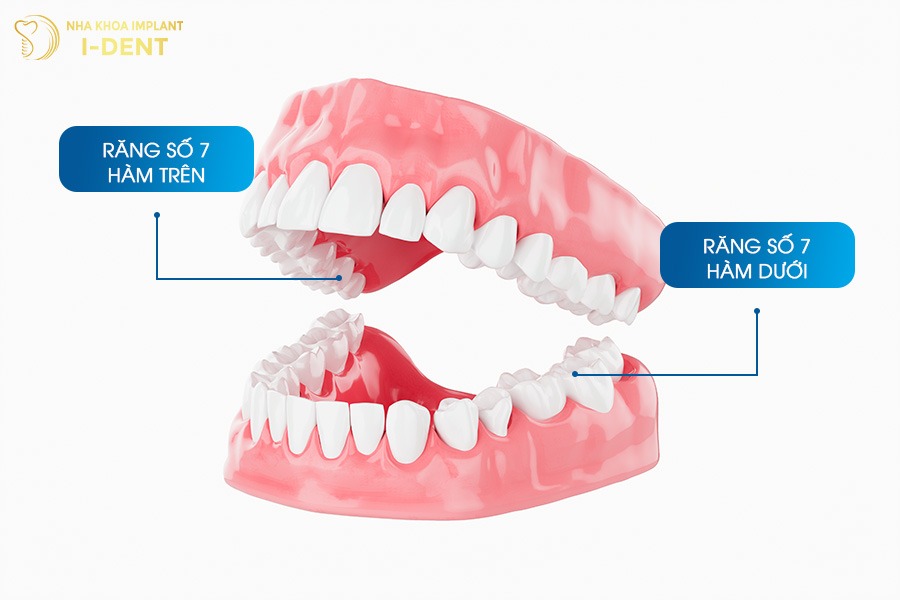 niềng răng số 7