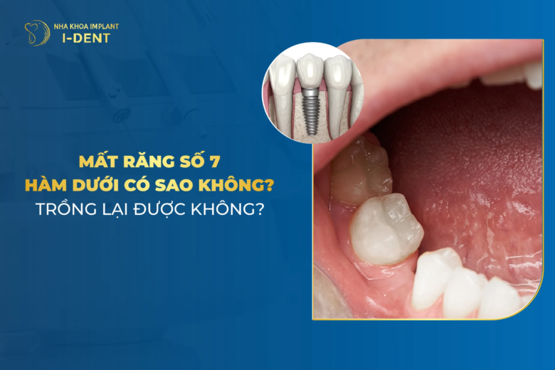 Mất răng số 7 hàm dưới: Hậu quả và cách khắc phục
