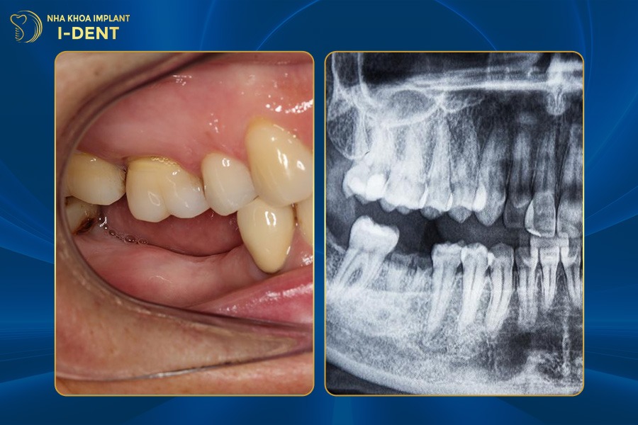 Mất răng tạo nên các khoảng trống trên hàm