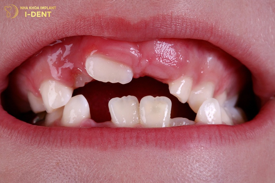 niềng răng cho trẻ 8 tuổi