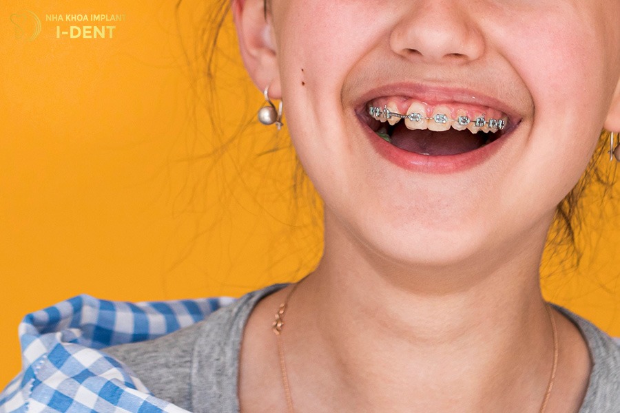 nên niềng răng cho trẻ 13 tuổi