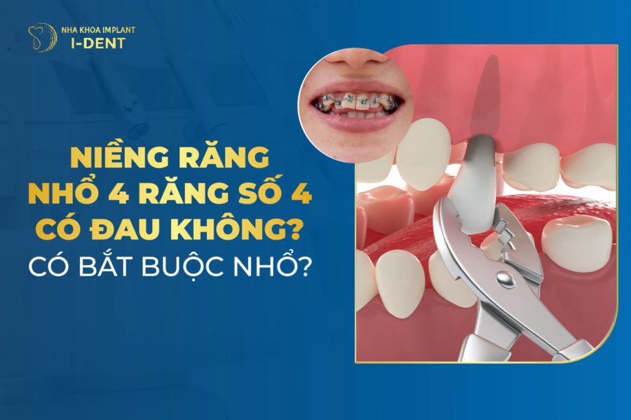 niềng răng nhổ răng số 4