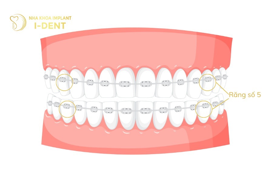Răng số 5 nằm giữa răng số 4 và răng số 6.