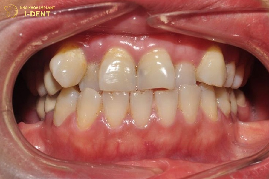 niềng răng 2 hàm giá bao nhiêu