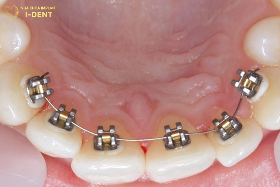 niềng răng bằng sắt