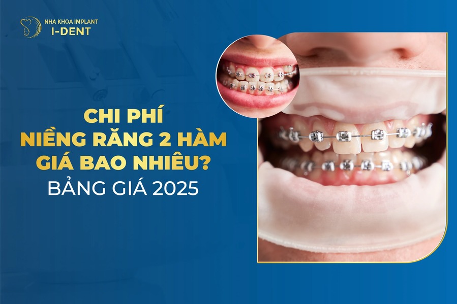 Niềng răng 2 hàm giá bao nhiêu? Bảng giá mới 2026