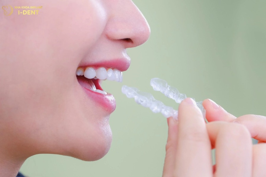 ưu điểm của niềng răng invisalign