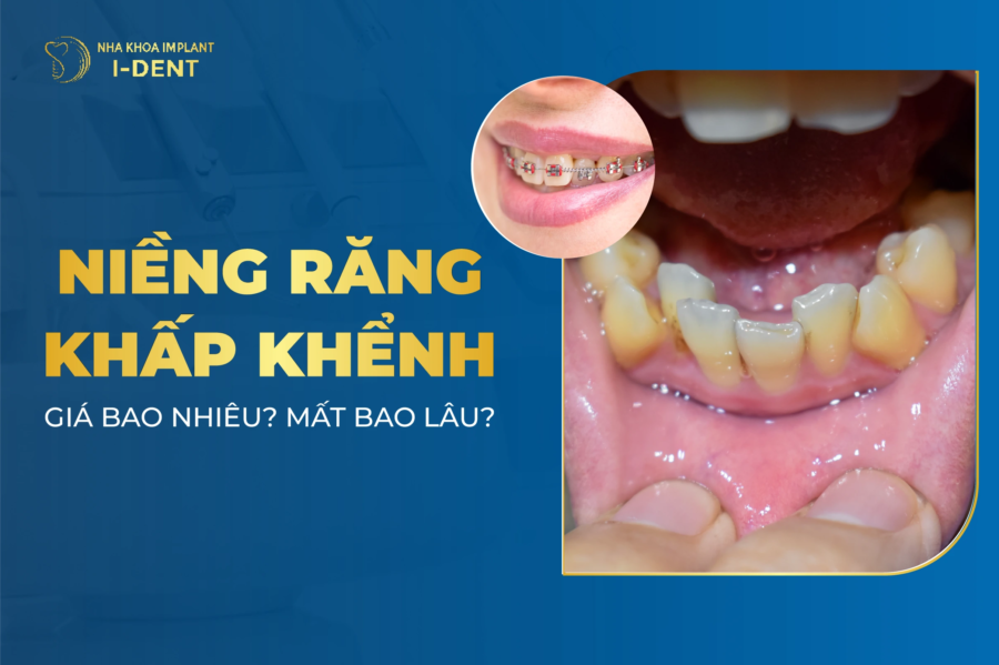 Niềng Răng Khấp Khểnh Giá Bao Nhiêu? Mất Bao Lâu?