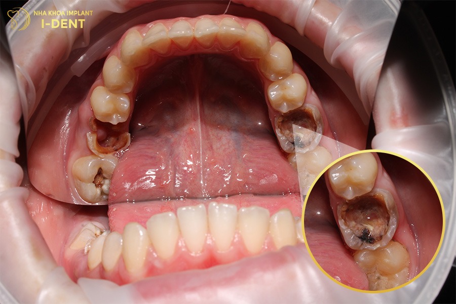 niềng răng khi mất răng số 6