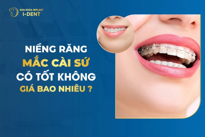 Niềng Răng Mắc Cài Sứ Là Gì? Giá và Ưu Nhược Điểm