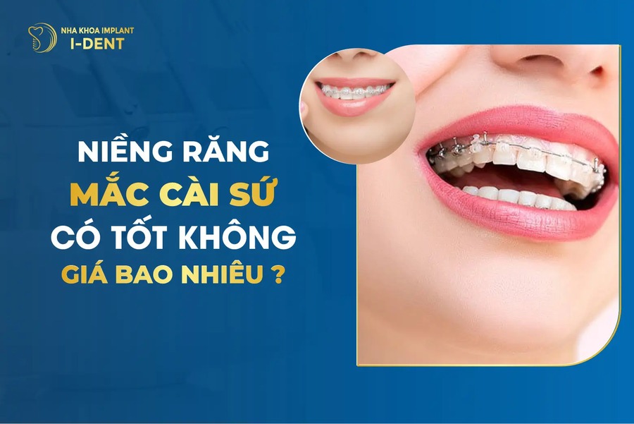 Niềng Răng Mắc Cài Sứ Là Gì? Giá và Ưu Nhược Điểm