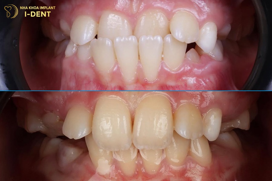 niềng răng cho trẻ 13 tuổi