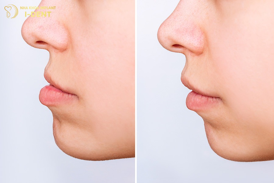 Niềng răng móm cái thiện khớp hàm