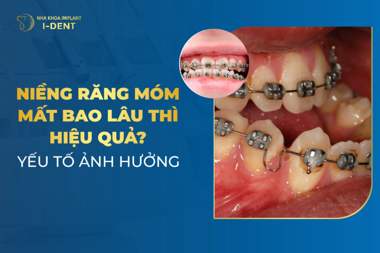 Niềng Răng Móm Trong Bao Lâu? Yếu Tố Ảnh Hưởng